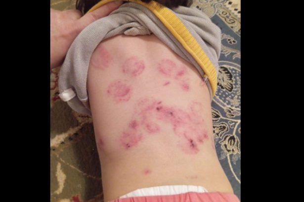 Балабақшадағы былық: "Қызылордада бір жарым жастағы баланы әлдекім тістелеп тастаған"